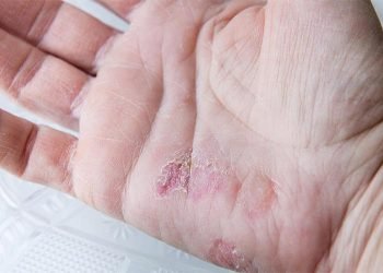 winter-skin-problems