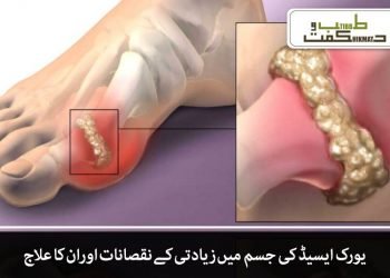 یورک ایسیڈ کی جسم میں زیادتی کے نقصانات اور ان کا علاج